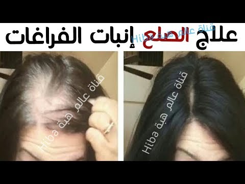 تعرّف على أقوى وصفة لمنع تساقط الشعر