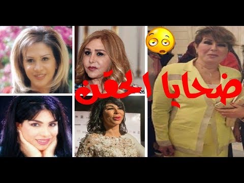 شاهد 15 فنانة شهيرة تشوهن بعد عمليات التجميل