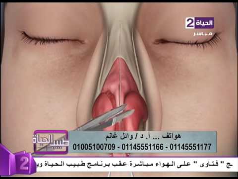 شاهد طريقة إجراء عملية جراحة تجميل الأنف