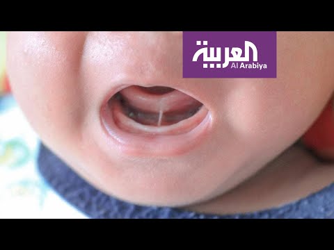 شاهد كيف نتعامل مع مشكلة ربط اللسان عند الأطفال