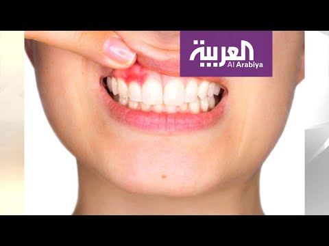 شاهد اللثة السليمة أساس لأسنان قوية لأسلوب حياة صحي